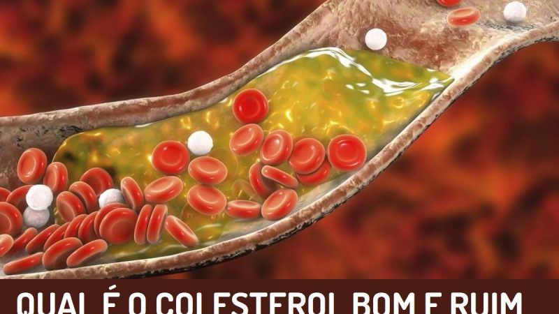 Entenda Qual é o Colesterol Bom e Qual é o Colesterol Ruim